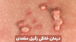 درمان خانگی زگیل مقعدی