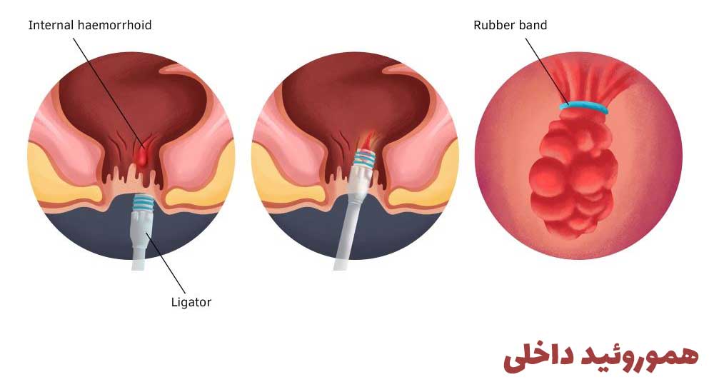 بواسیر داخلی