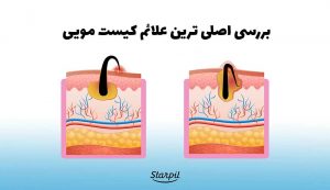 علائم کیست مویی