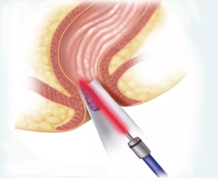 درمان فیستول با لیزر