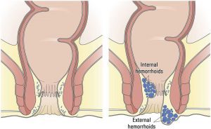 بررسی عوارض هموروئید