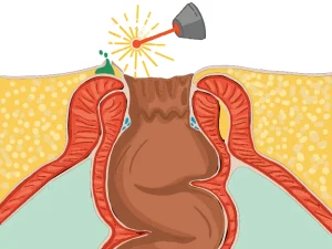 درمان آبسه مقعدی با لیزر