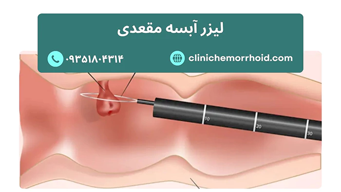 درمان آبسه مقعدی با لیزر در کلینیک هموروئید