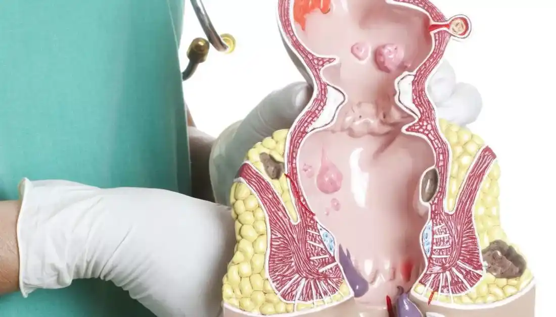 هموروئید در بارداری