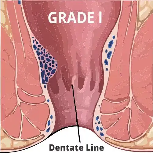 هموروئید در بارداری