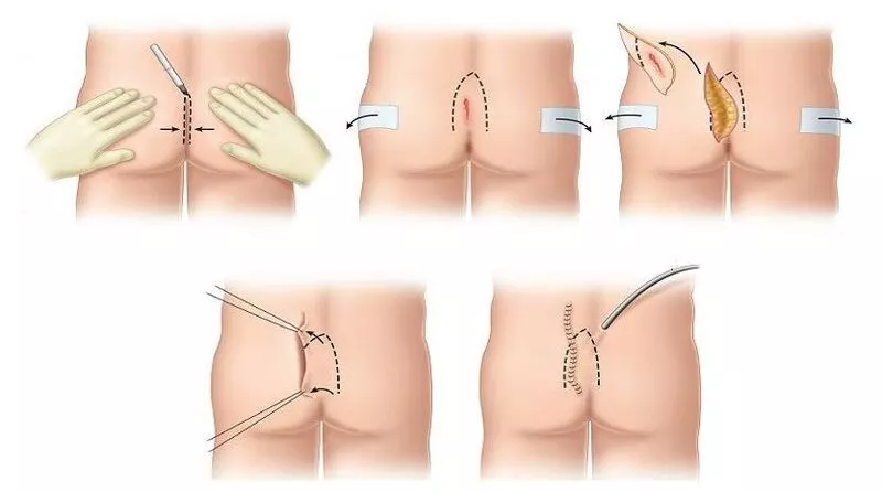 عمل کیست مویی بسته