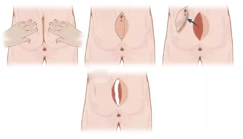 عمل کیست مویی باز