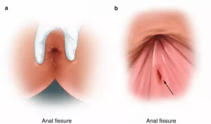 درمان خانگی شقاق
