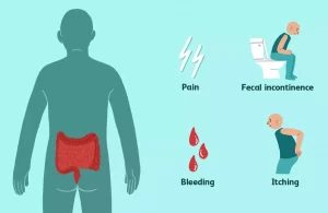 خارش بواسیر