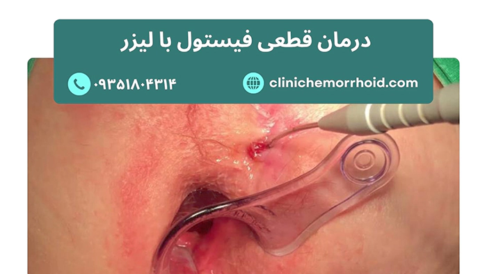 درمان قطعی فیستول با لیزر
