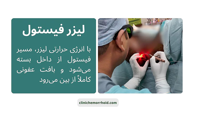 لیزر فیستول مقعدی