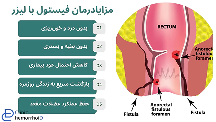 مزایا درمان فیستول با لیزر