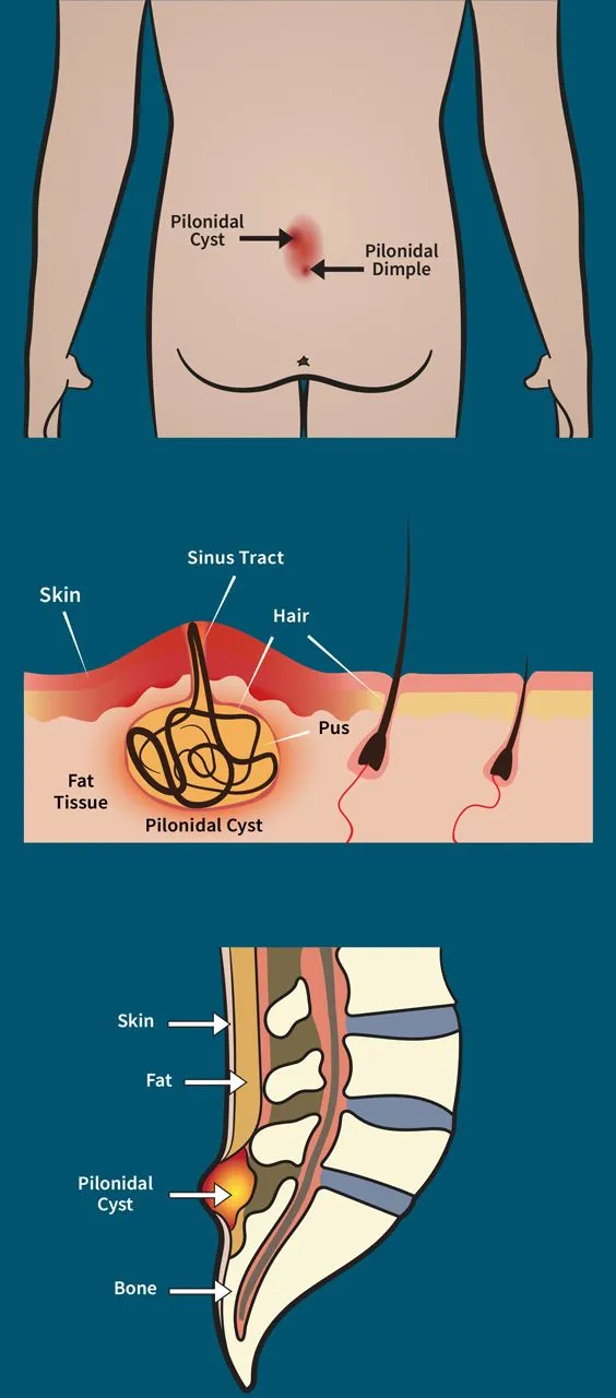 لیزر کیست مویی