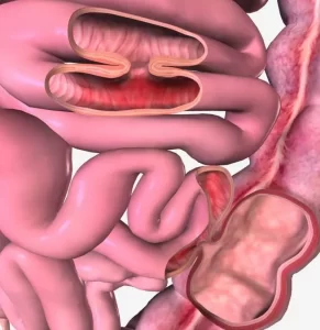 فیستول گوارشی