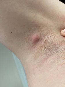 توده زیر بغل