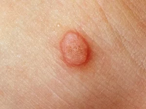 زگیل ناحیه تناسلی