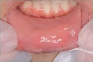 درمان فیستول لب