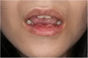 درمان فیستول لب