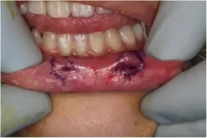 درمان فیستول لب