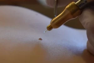 کرایوتراپی برای ضایعات پوستی