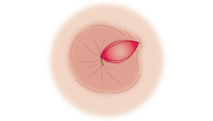 لیزر شقاق مقعدی