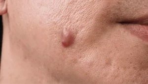 عوارض عدم درمان کیست مویی