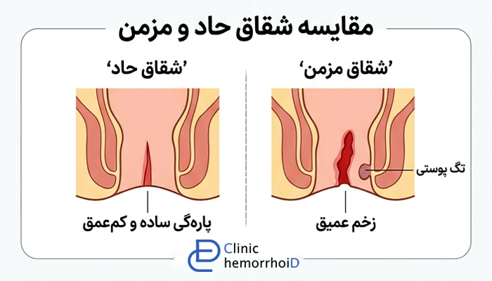 انواع شقاق مقعدی