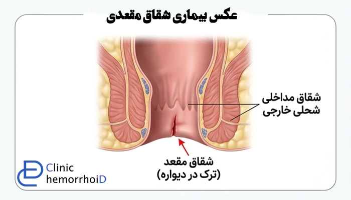 عکس بیماری شقاق مقعدی