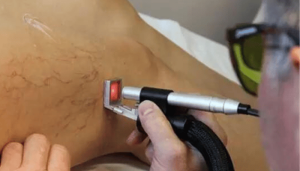 هزینه لیزر کیست مویی