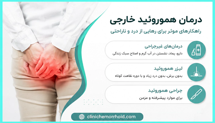 درمان بواسیر خارجی