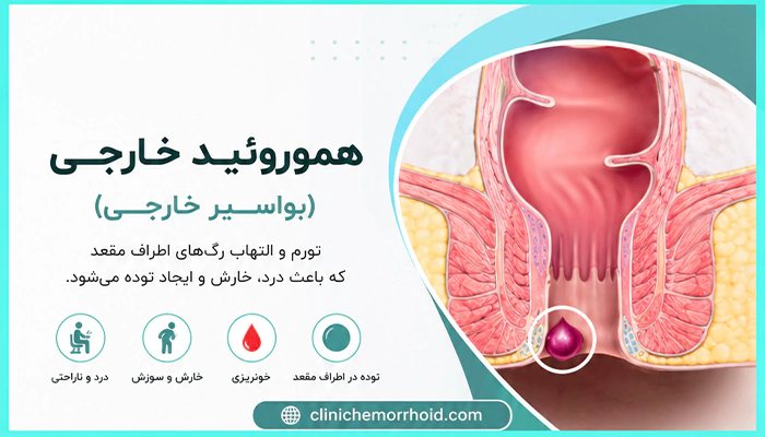هموروئید خارجی