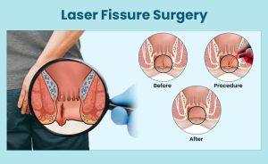 مزایا و معایب درمان شقاق با لیزر