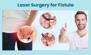 مزایا و معایب درمان فیستول با لیزر
