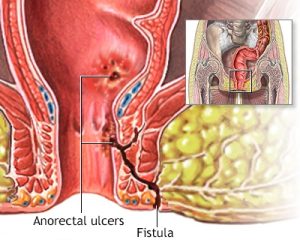 عوارض عدم درمان فیستول
