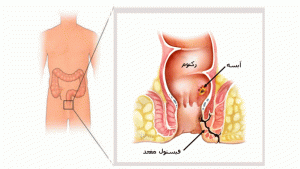 تفاوت فیستول در آقایان و خانم ها