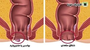 تفاوت شقاق و بواسیر