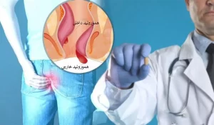 طول درمان هموروئید