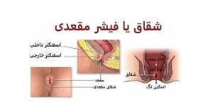 روش های درمان شقاق چیست؟
