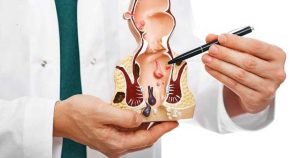 علائم ابتلا به هموروئید