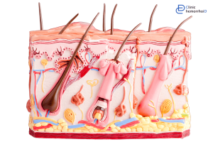 کیست مویی درزنان چیست؟