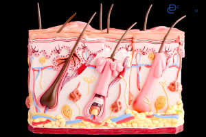 کیست مویی: بررسی علل و عوامل زمینه ساز
