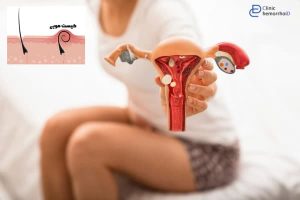 انتخاب لباس مناسب برای پیشگیری از کیست مویی