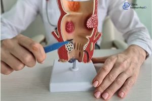 هزینه لیزر هموروئید