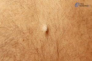 کیست مویی در مردان چیست؟