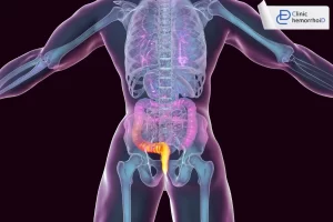 نقش پنهان ژنتیک در بیماری هموروئید