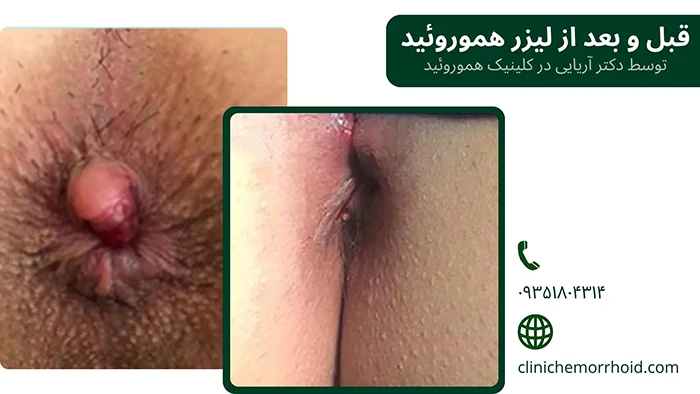 قبل و بعد از لیزر هموروئید