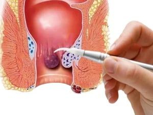 لیزر بواسیر