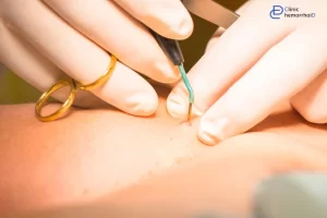 از کجا بفهمیم زگیل تناسلی داریم؟