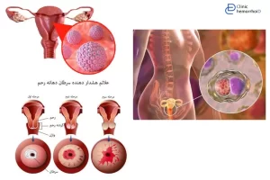 زگیل تناسلی و ارتباط آن با سرطان دهانه رحم