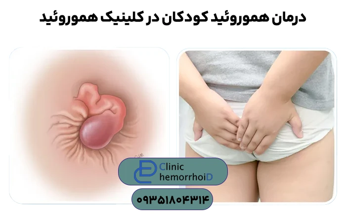 درمان هموروئید کودکان در کلینیک هموروئید